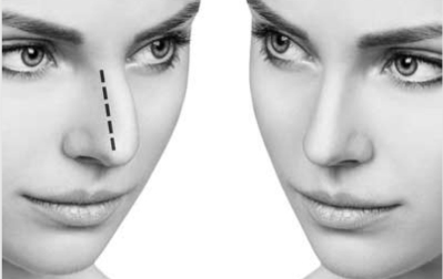 conseils dormir après rhinoplastie