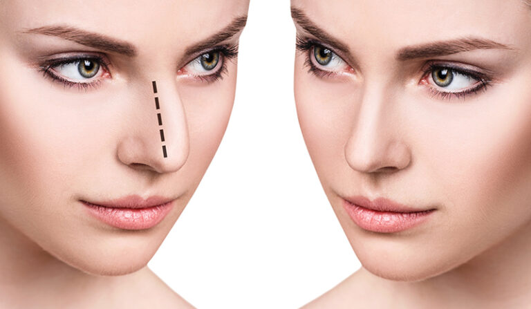 Rhinoplastie Médicale